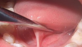 基本简介 舌系带 正常舌系带是位于口底前方舌尖下面正中的粘膜皱襞.