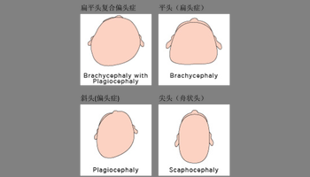 扁头综合症