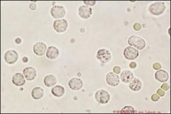 尿白细胞++镜检(4-5)尿红细胞+-镜检(1-2)尿微