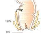 一般是指肛裂日久所导致的肛乳头瘤或肛乳头炎,哨兵痔,陈旧性肛裂