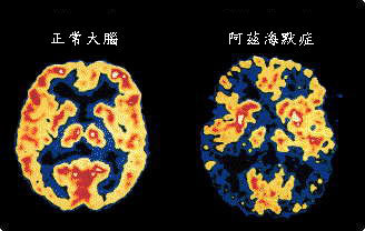 阿茨海默症