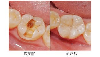 龋牙治疗方法